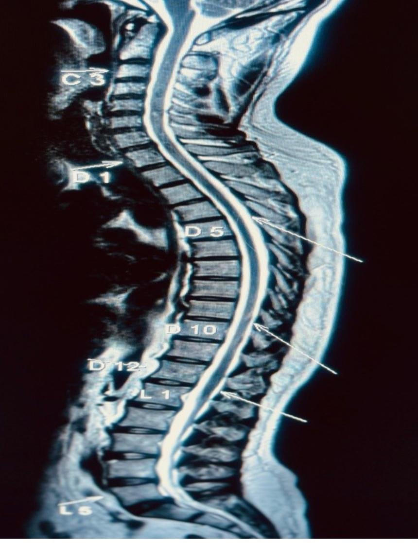 Glowing 3D Spine Central Neuraxial Blockade